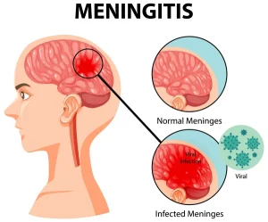 biaya suntik meningitis di puskesmas